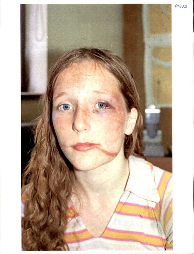 A girl with a bruised face and rope burn