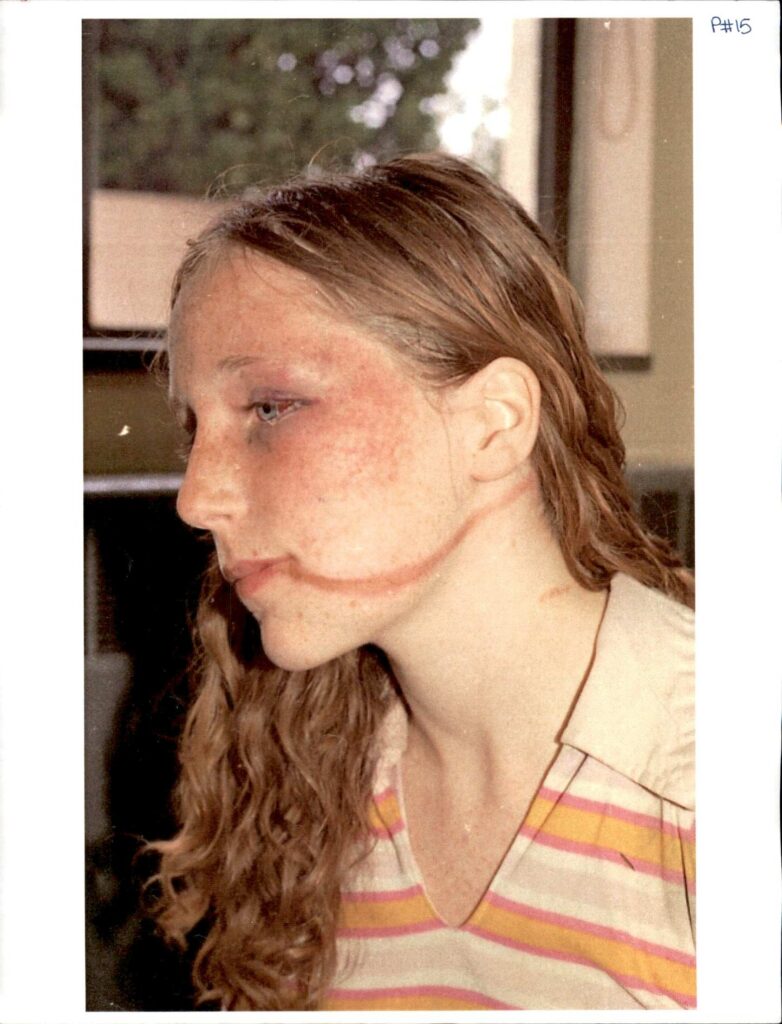 Young girl with rope burns on her bruised face.