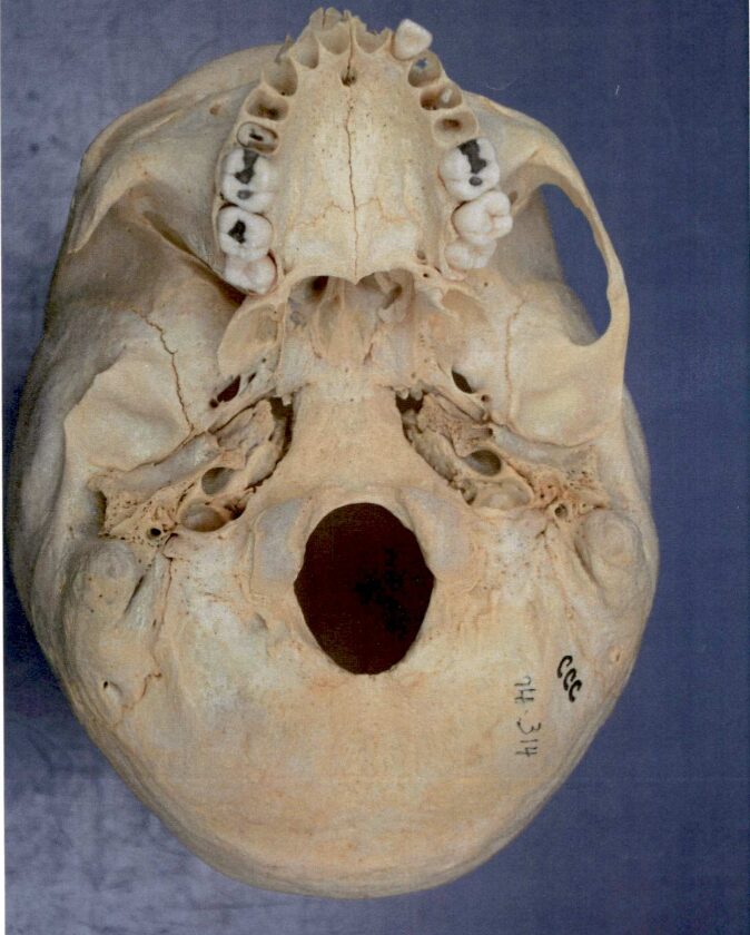 A human skull photographed by law enforcement.